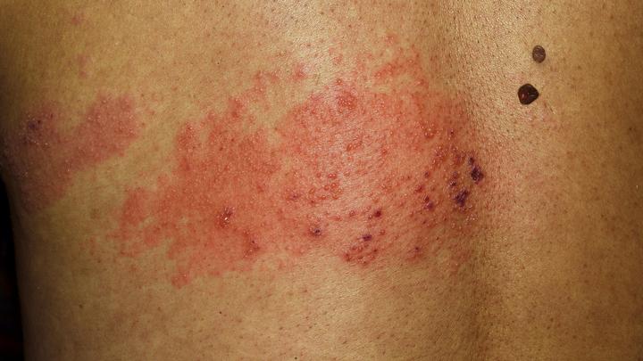 Русские должны знать: Мир столкнулся с инфекцией, разъедающей тело