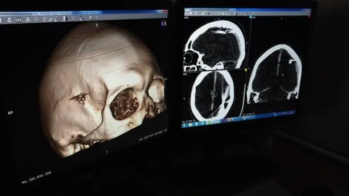 Сутки с пулей в голове: нейрохирурги спасли пациента с уникальным ранением