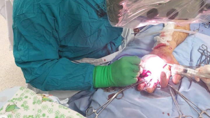 Краснодарские хирурги спасли мужчине кисть руки, поврежденную пилой