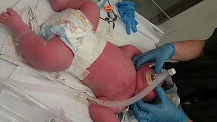 В челябинской ОКБ №2 врачи спасли новорожденного с осложнениями при ковидной пневмонии
