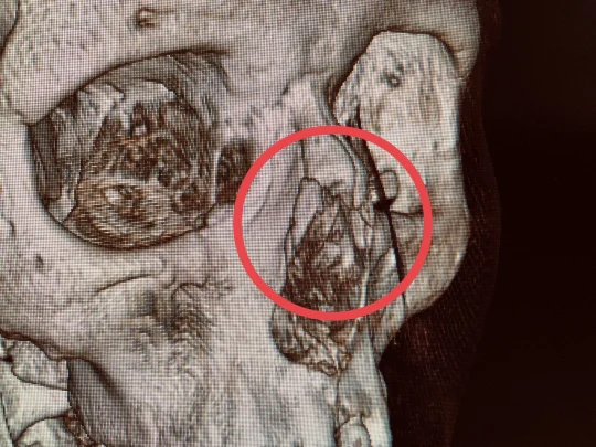 В Подмосковье девушка выронила телефон из руки и сломала себе нос