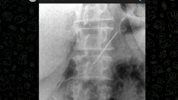 Месяц в животе: в Подмосковье врачи достали из женщины 4 швейные иглы