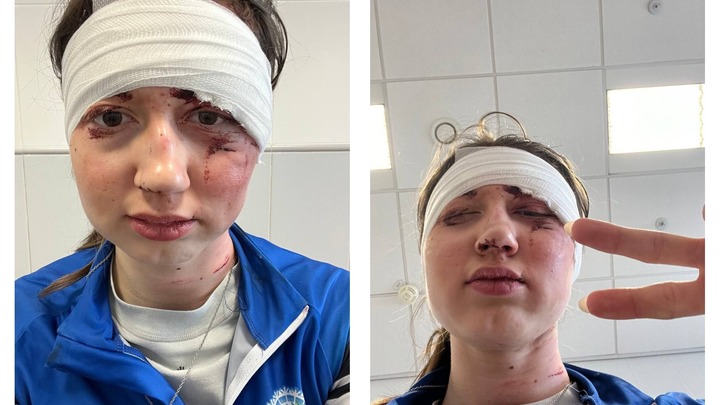 Гонка прошла удачно, ставлю 10 из 10: Лыжница показала травмы после завала на Спартакиаде