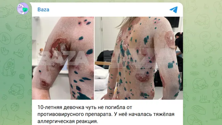 Слезала кожа: таблетка от вируса едва не убила 10-летнюю девочку