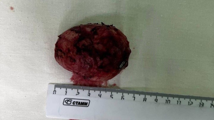 В Краснодаре онкологи удалили редкую опухоль